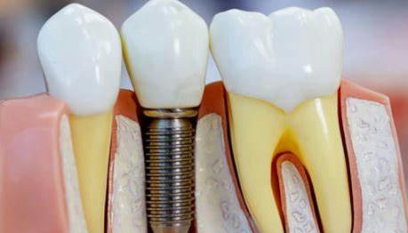 The Modern Development of Dental Implants